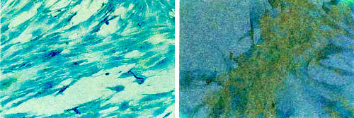 Культура человеческих клеток, в которой произошло максимально возможное число делений (справа), содержит вариант белка фибронектина (бурые пятна), выявленного при помощи моноклональных антител, полученных М. Портер из Медицинского колледжа Бэйлора. В культуре молодых клеток (слева) нет такой формы фибронектина